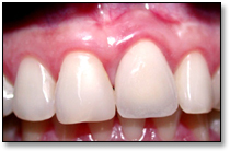 Laser Tooth Whitening, laser tooth whitennig, Scaling, scaling, Dental Cosmetics, dental cosmetics, Procelain Crown, procelain crown, Whitening, whitening, Laser, laser