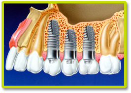 DENTAL IMPLANT AND IMPLANTS  THAILAND, Dental Implant and implants Bangkok  Thailand, Dental Implant Case By  Bangkok Dental Clinic Thailand