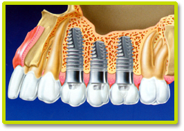 DENTAL IMPLANT AND IMPLANTS THAILAND, Dental Implant and implants Bangkok Thailand, Dental Implant Case By Bangkok Dental Clinic Thailand